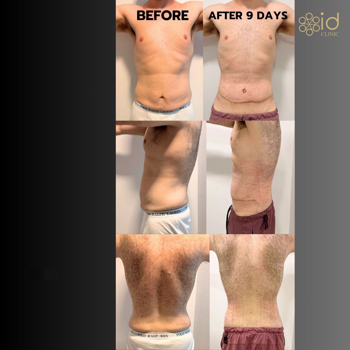 Before and after tummy tuck results at ID Clinic Bangkok, visible abdominal contour improvement