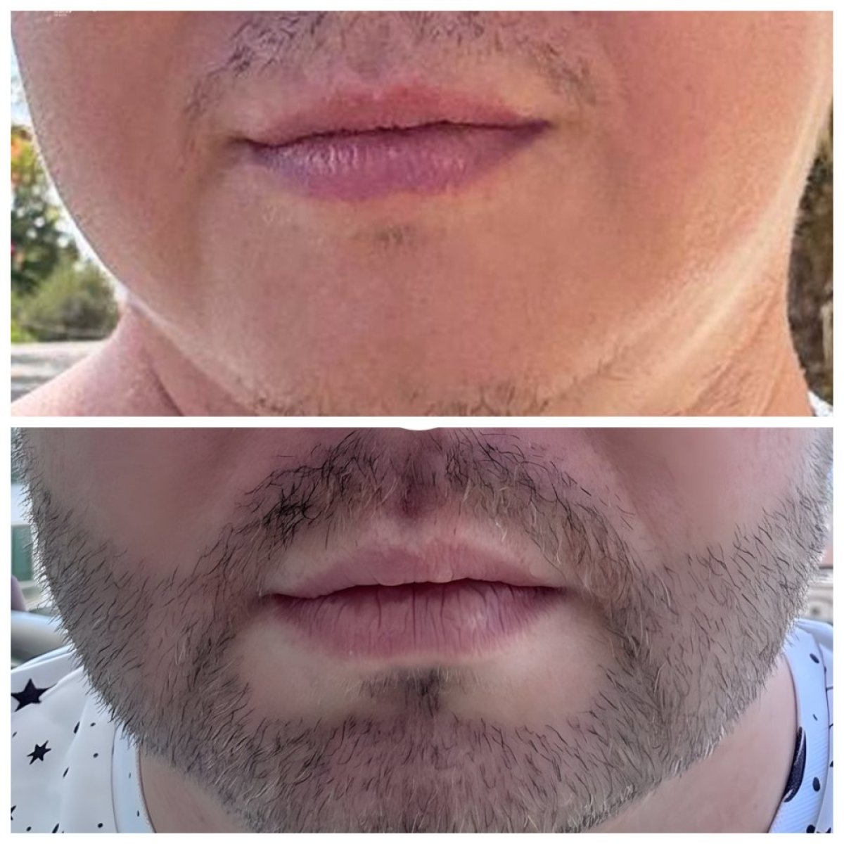 Before and after beard transplant results at Soraca Med – fuller facial hair restoration