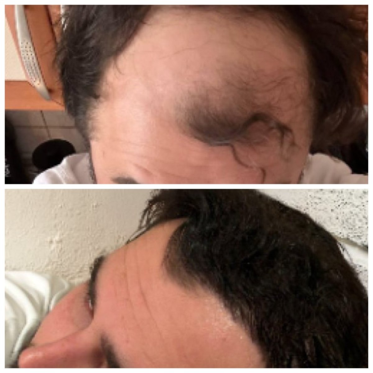 Before and after hair transplant at Soraca Med, restored hairline and fuller hair result