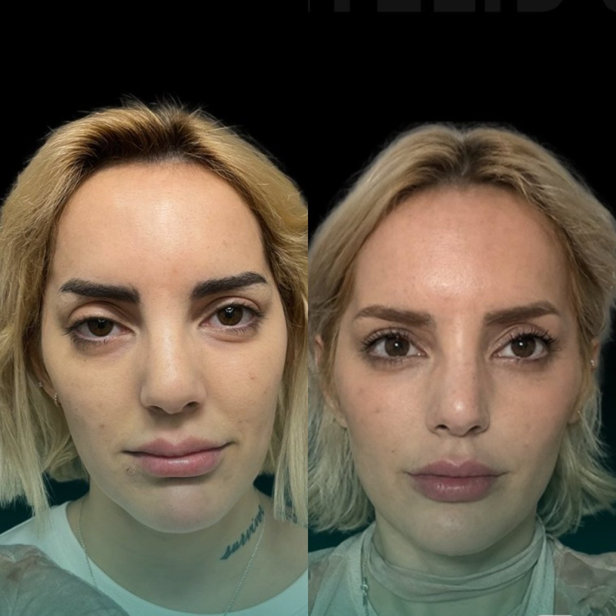 Resultados de blefaroplastia antes y después en Soraca Med – corrección de párpados