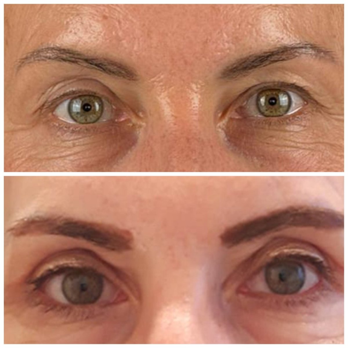 Before and after blepharoplasty results at Soraca Med, eyelid correction for youthful eyes