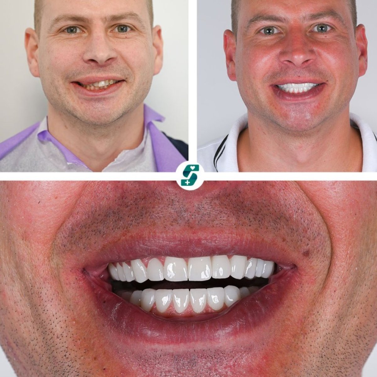 Antes y después de coronas de zirconia en Soraca Med, resultado de sonrisa mejorada