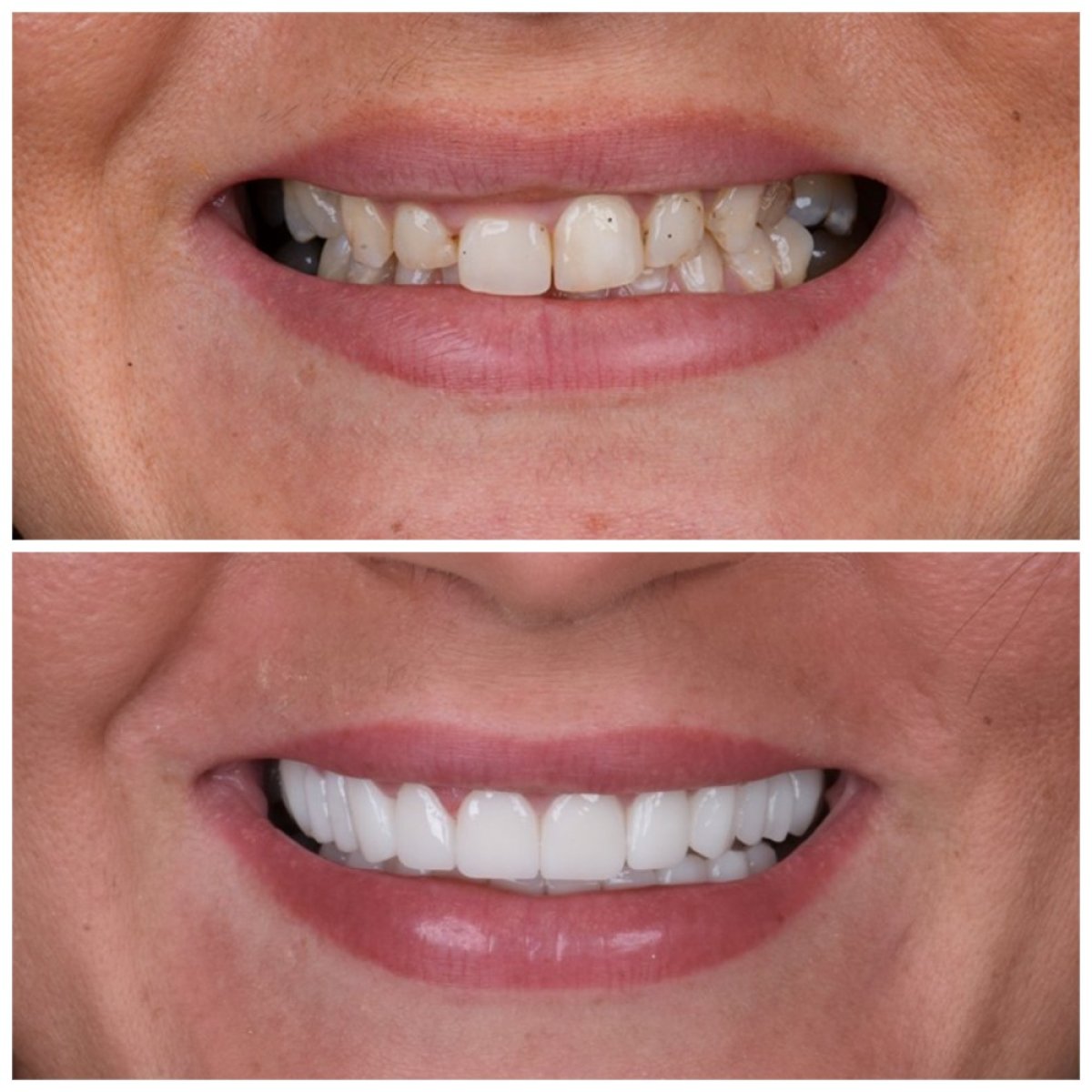 Antes y después de coronas de zirconia en Soraca Med: resultados de transformación de sonrisa