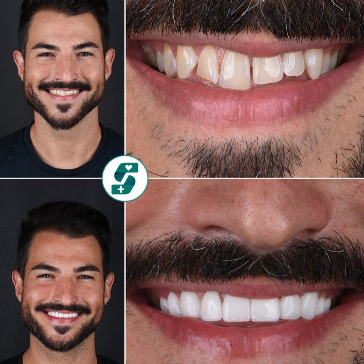 Before and after zirconia crown installation at Soraca Med – smile makeover results
