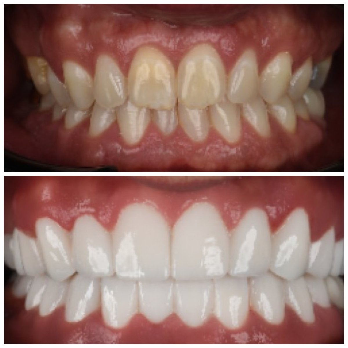 Before and after zirconia crown installation at Soraca Med, visible smile transformation result