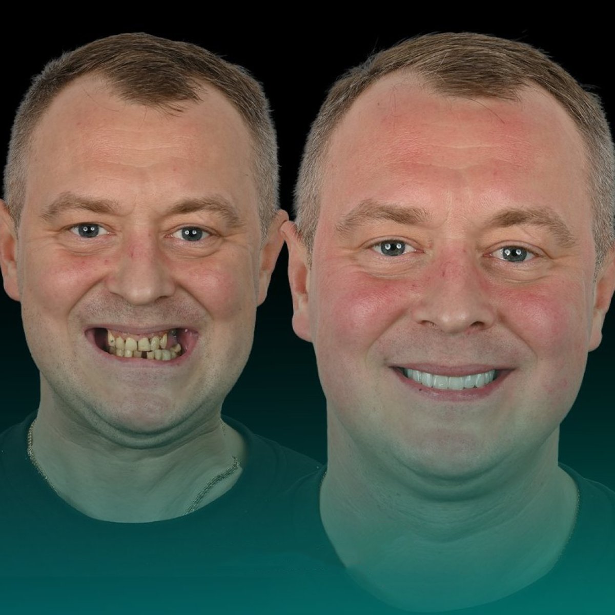 Before and after zirconia crown installation at Soraca Med, smile makeover result