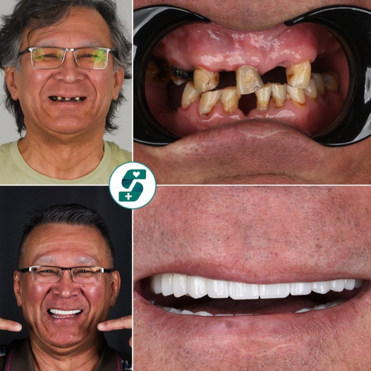 Before and after All-on-6 dental implants at Soraca Med, full smile restoration results