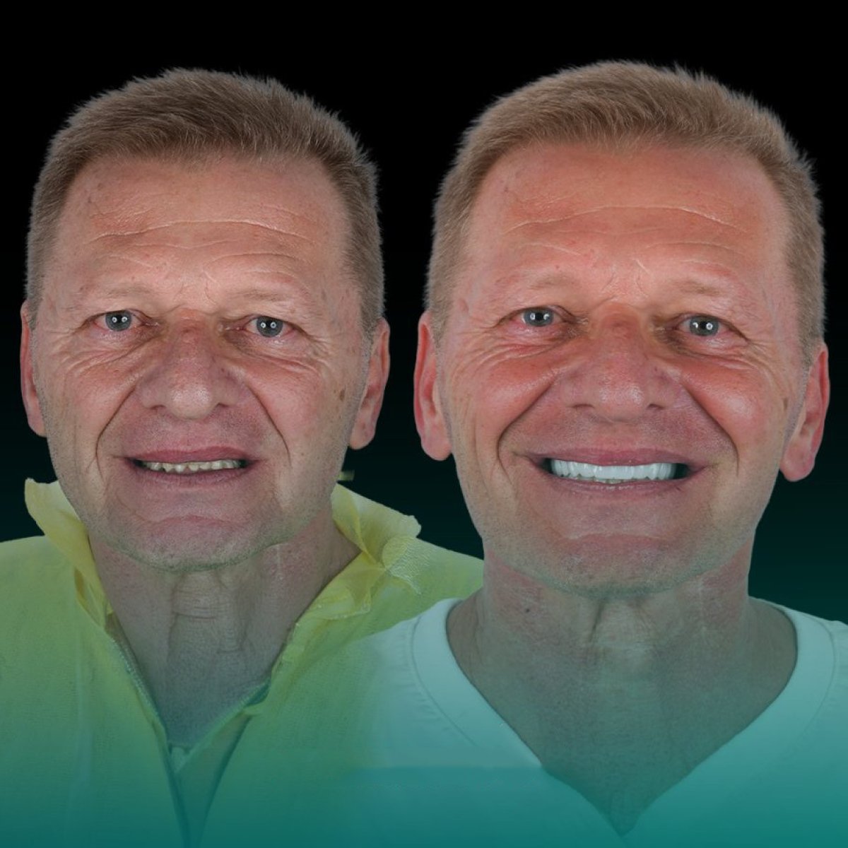 Before and after zirconia crown installation at Soraca Med, improved smile aesthetics result