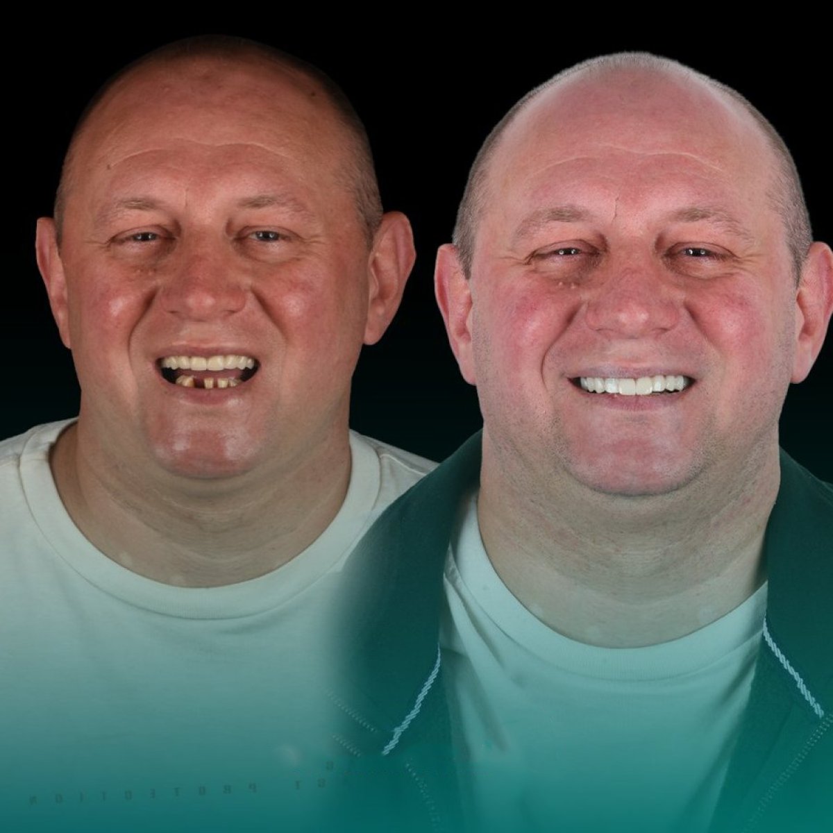 Before and after All-on-6 dental implants result at Soraca Med – full smile restoration