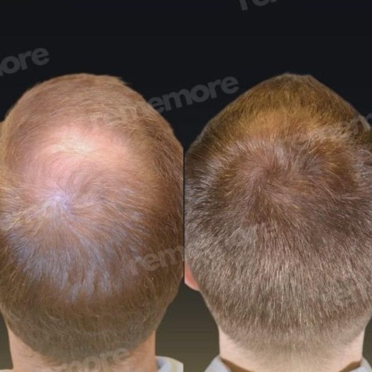 Résultats greffe de cheveux avant/après à Memorial Bahçelievler Hospital, densité accrue