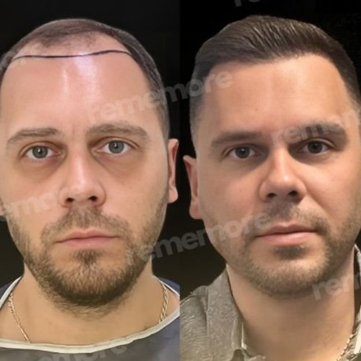 نتائج زراعة الشعر قبل وبعد في مستشفى ميموريال بهجيليفلر، خط شعر مستعاد