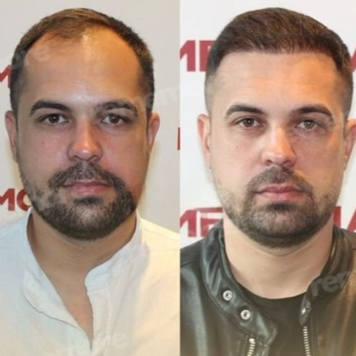 نتائج زراعة الشعر قبل وبعد في مستشفى ميموريال بهجيليفلر، استعادة خط الشعر
