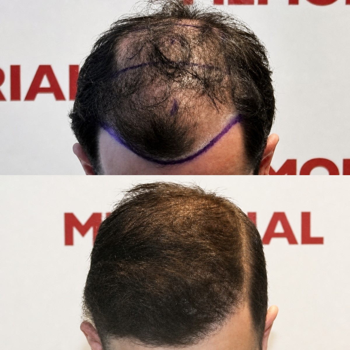 نتائج زراعة الشعر قبل وبعد في مستشفى ميموريال بهجيليفلر، استعادة خط الشعر