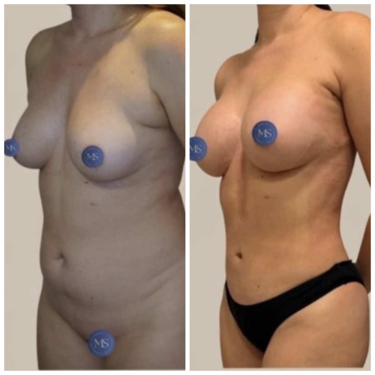 Resultados de liposucción antes y después en Dr. Michel Salameh - contorno corporal estético