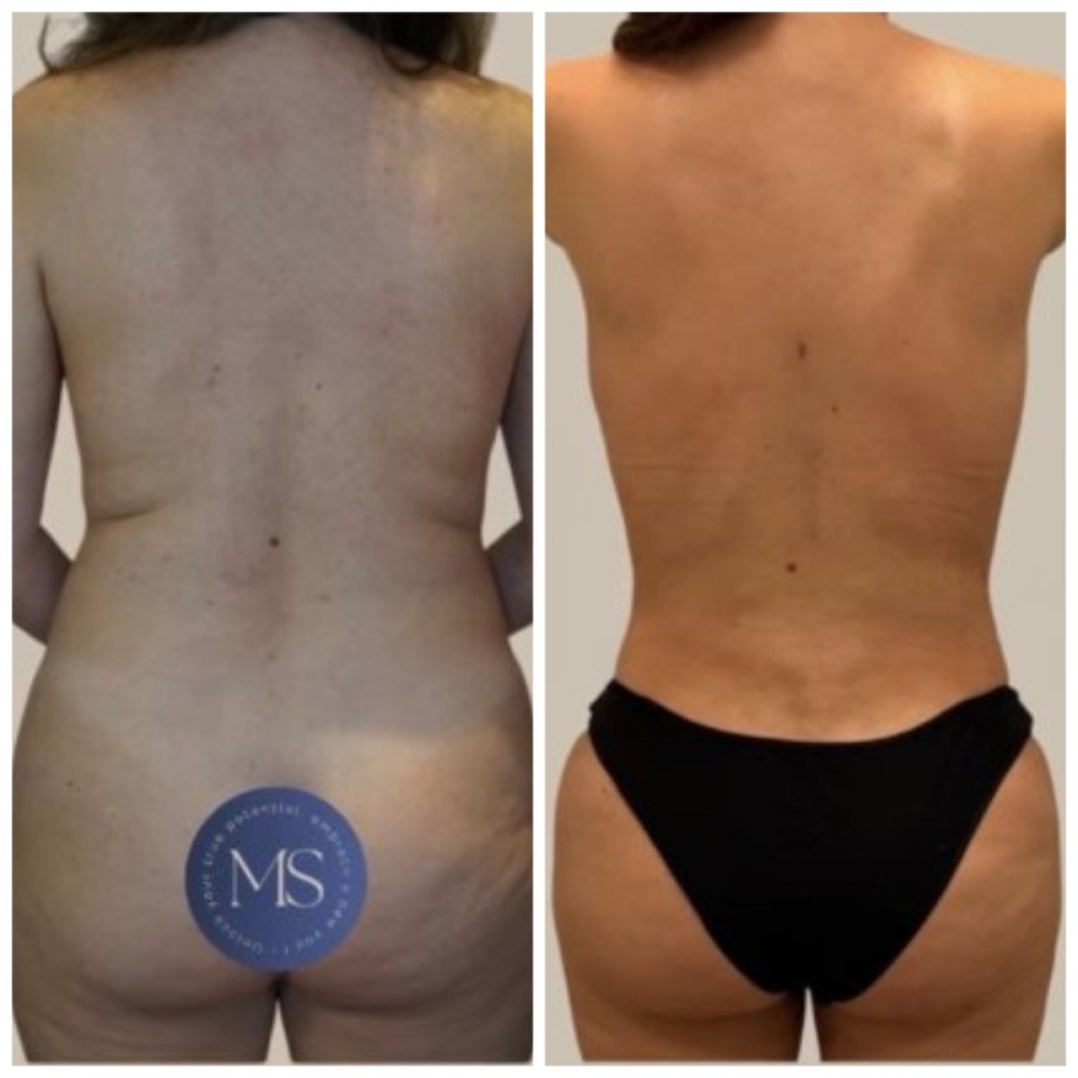Результаты липосакции до и после в Dr. Michel Salameh - Plastic And Aesthetic Surgery, стройная талия
