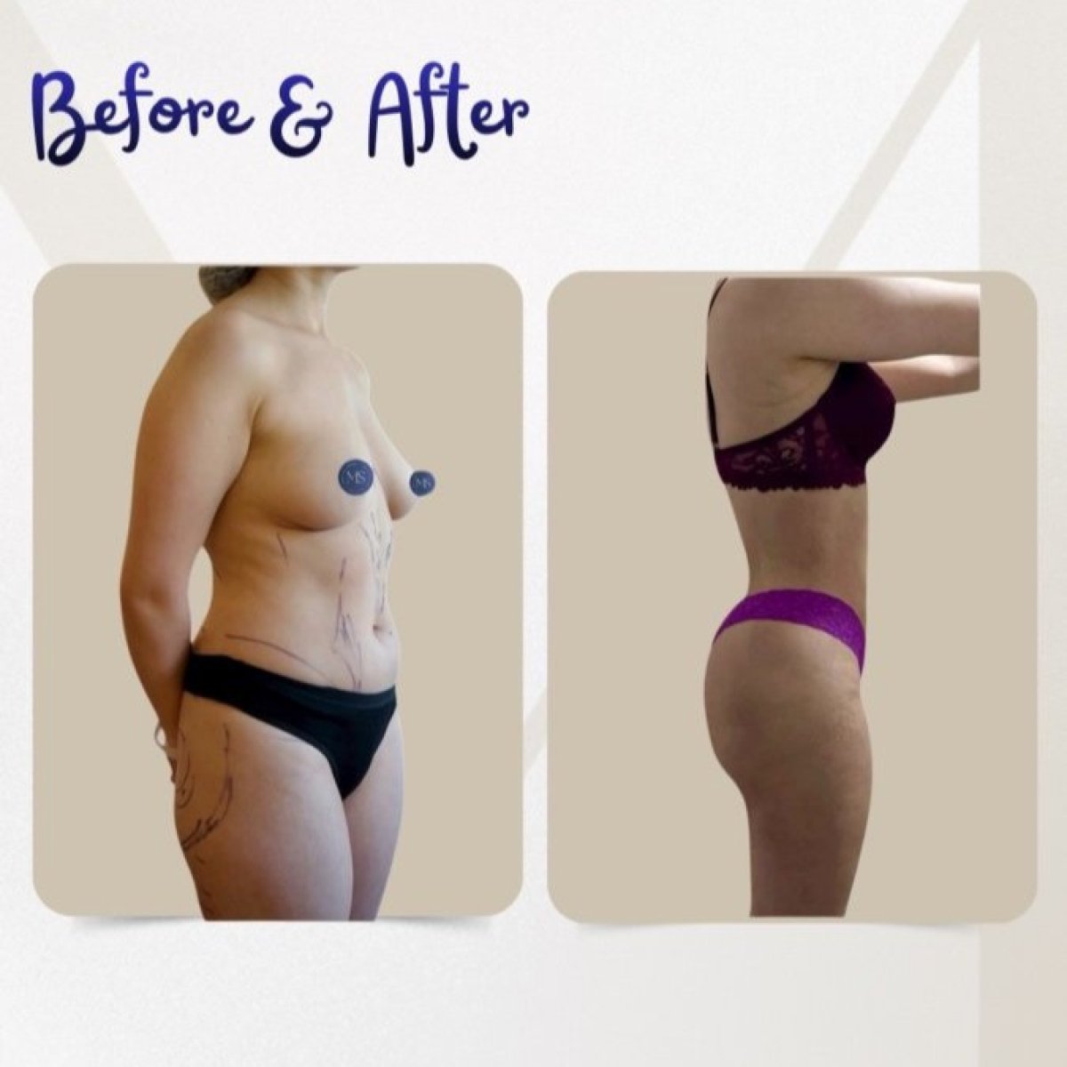 نتائج شفط الدهون قبل وبعد في عيادة Dr. Michel Salameh - Plastic And Aesthetic Surgery