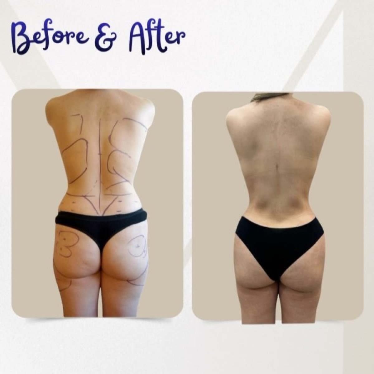 نتائج شفط الدهون قبل وبعد في عيادة Dr. Michel Salameh - Plastic And Aesthetic Surgery