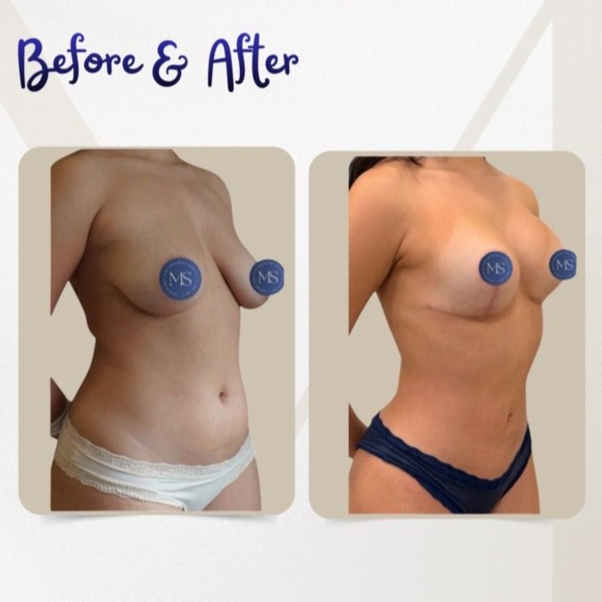 نتائج شفط الدهون قبل وبعد في عيادة Dr. Michel Salameh - Plastic And Aesthetic Surgery