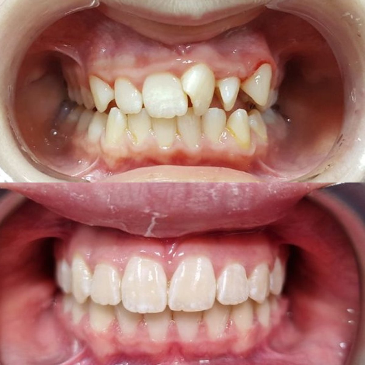 Результаты до и после брекетов в Dental Clinic Dynasty Stomatology в Праге, выравнивание зубов