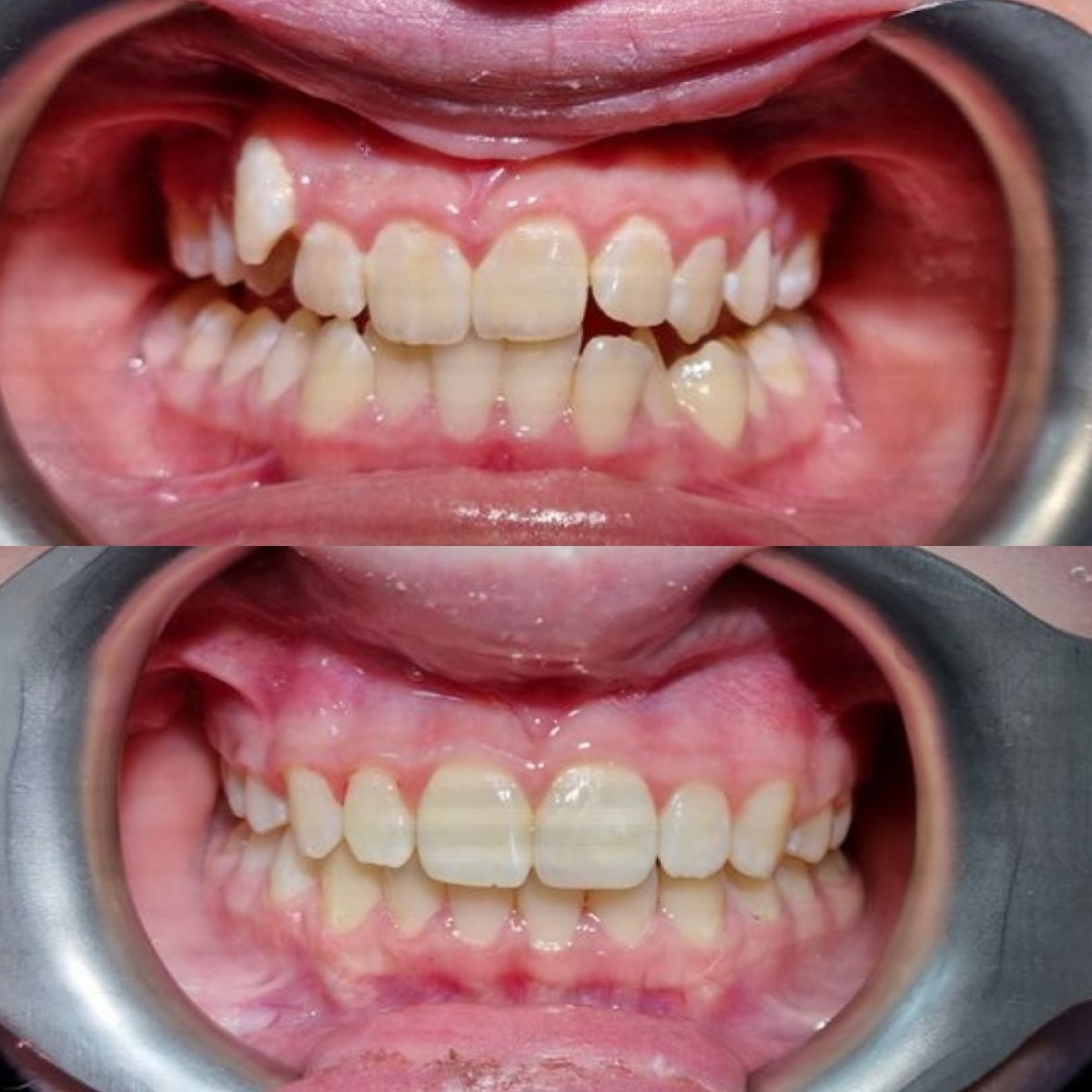 Resultados antes y después de ortodoncia en Dental Clinic Dynasty Stomatology en Praga, alineación dental