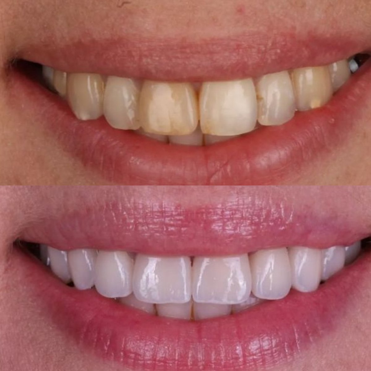 Before and after veneers result at Dental Clinic Dynasty Stomatology in Prague, smile makeover