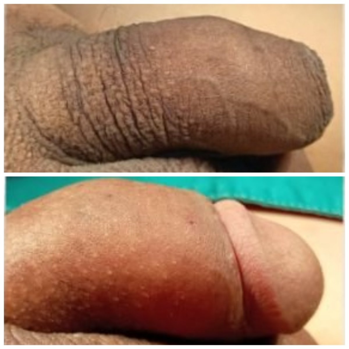 نتائج تكبير القضيب قبل وبعد في عيادة Menness Wellness Clinic، زيادة واضحة بالحجم