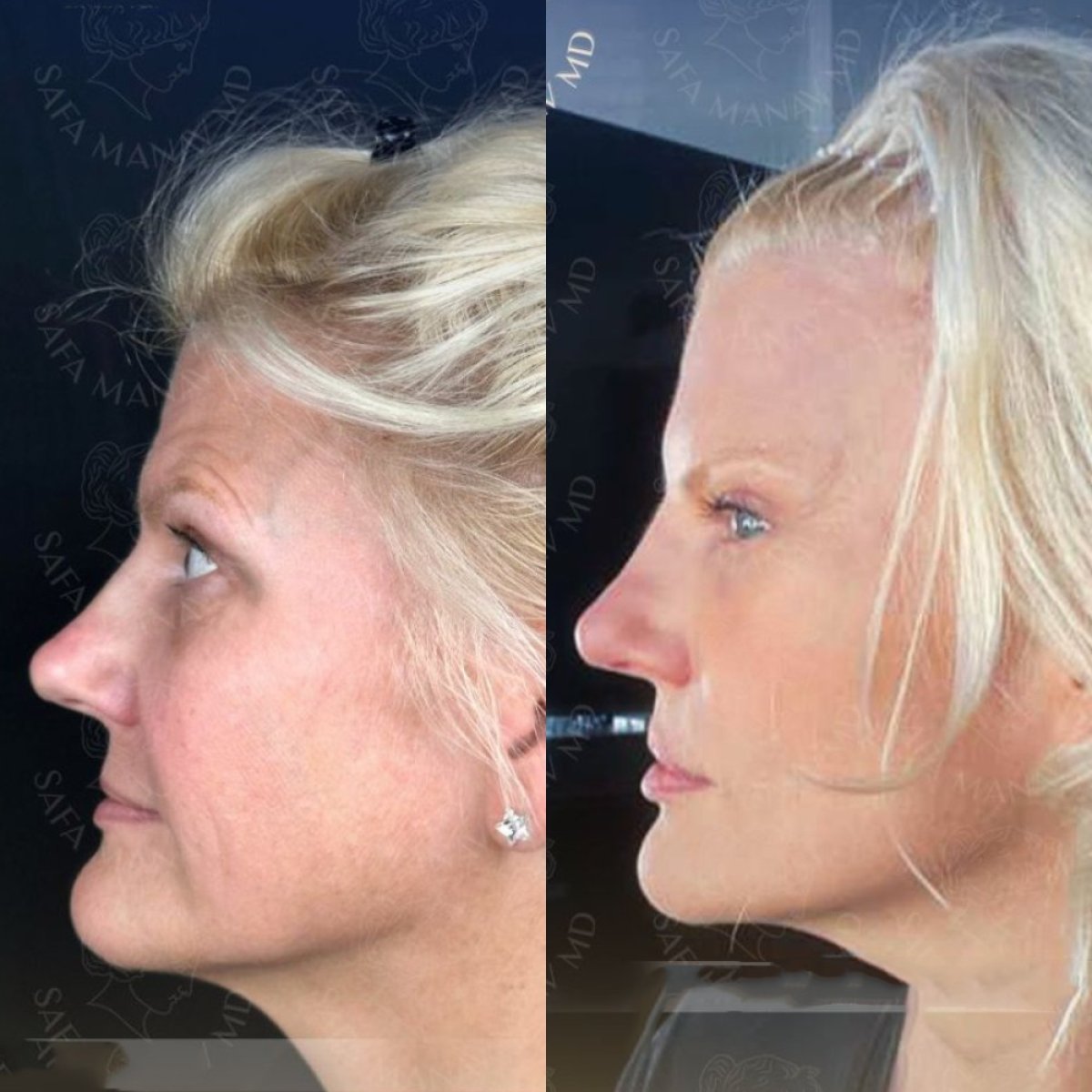 Resultados de transferencia de grasa facial antes y después en Dr. Safa Manav Clinic