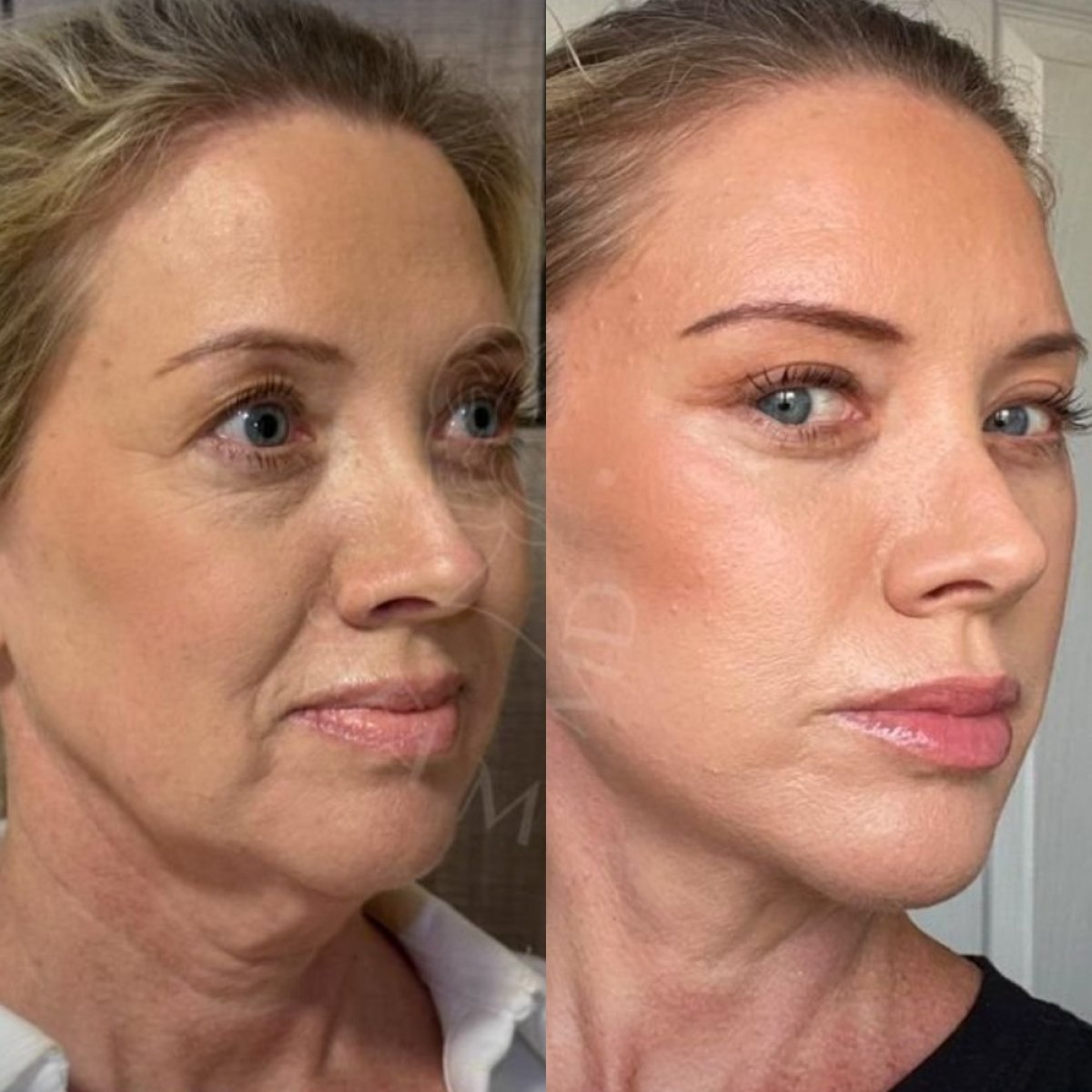 Resultados de lifting facial antes y después en Dr. Safa Manav Clinic – rejuvenecimiento visible