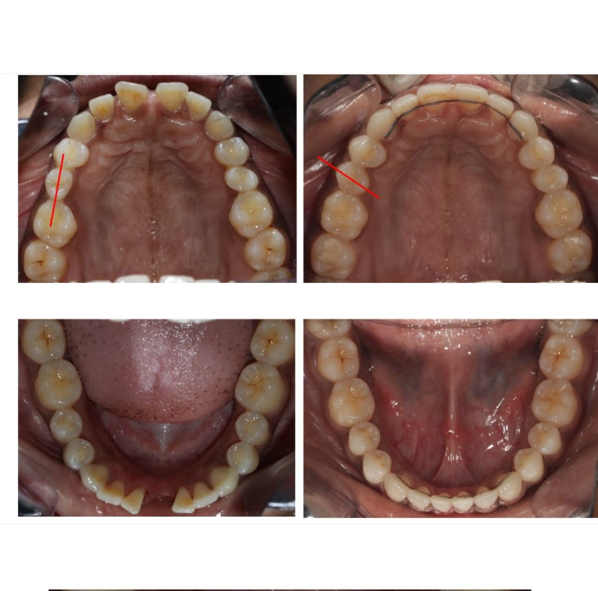Результаты до и после Invisalign – выравнивание зубов и более ровная улыбка