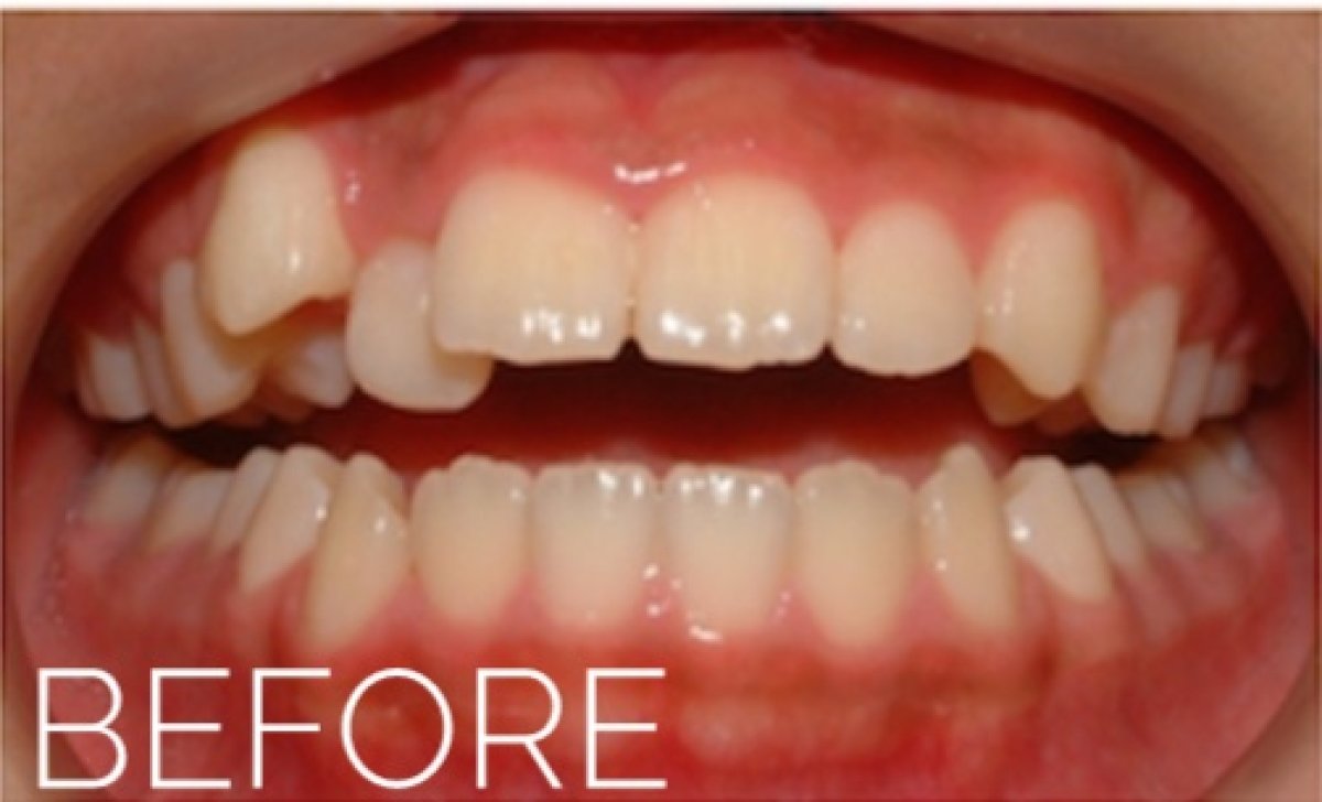 نتيجة قبل علاج Invisalign – أسنان غير منتظمة وفراغات قبل التصحيح التقويمي
