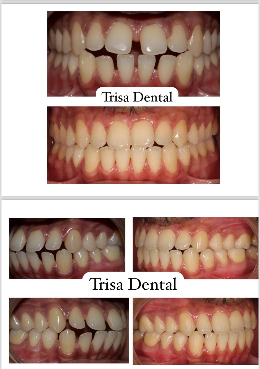 Результаты до и после Invisalign в Trisa Dental – выравнивание зубов и улучшение улыбки