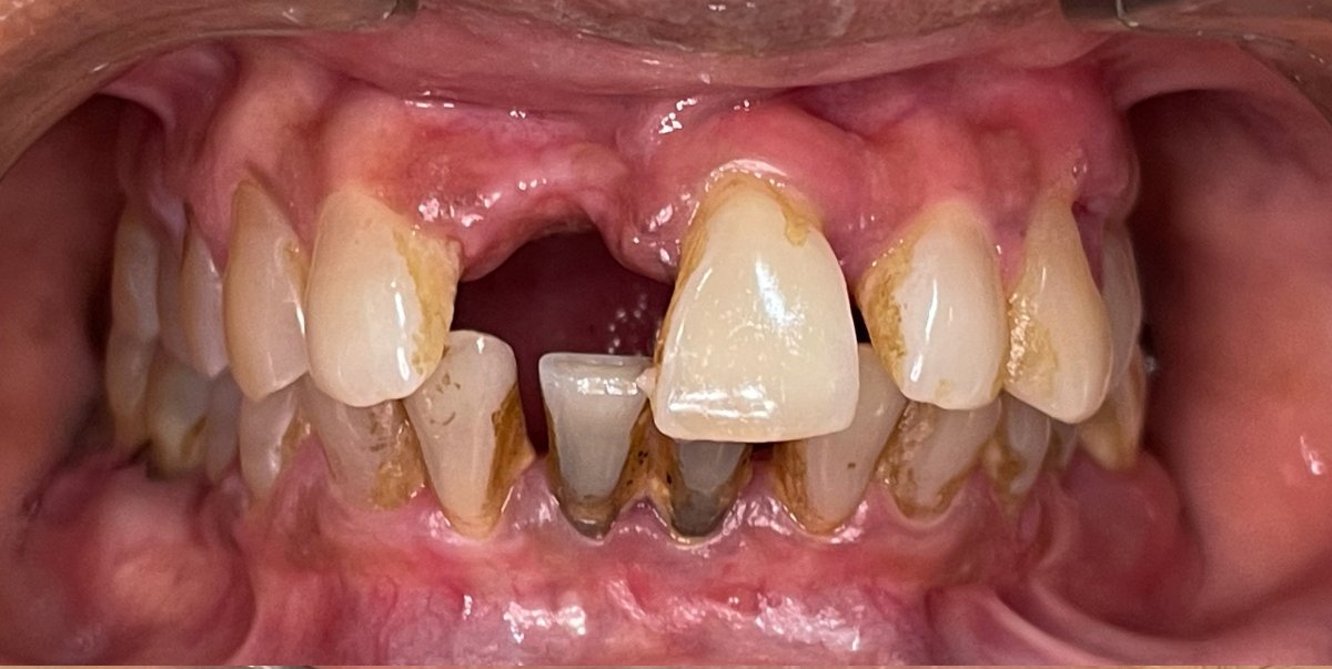 Before All-on-6 dental implants procedure, missing and damaged teeth visible in upper jaw