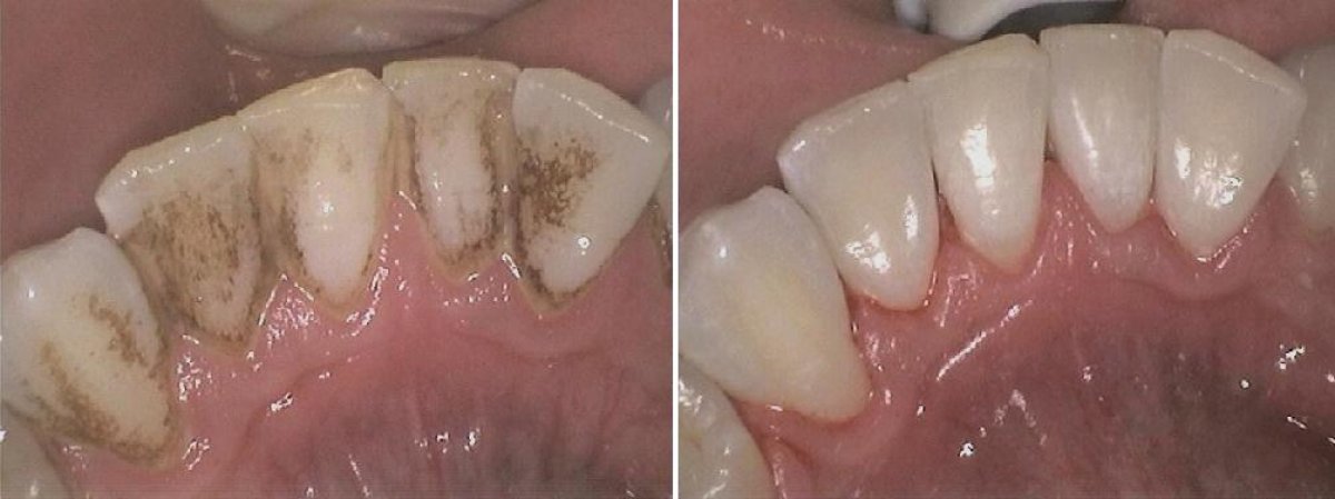 Before and after deep cleaning (scaling and root planing) results – improved dental hygiene