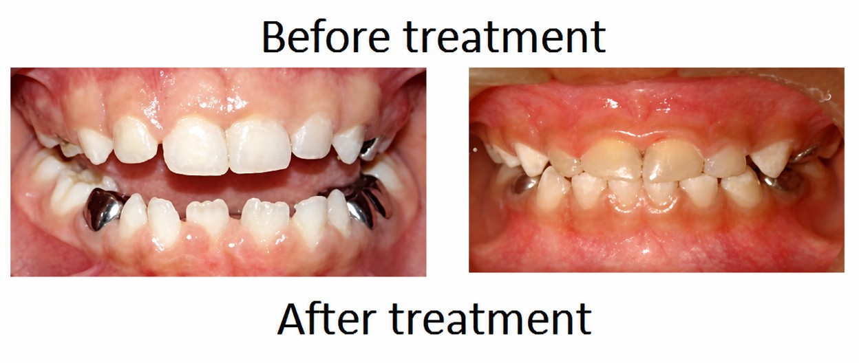 Resultados de tratamiento de ortodoncia antes y después: alineación dental y corrección de mordida