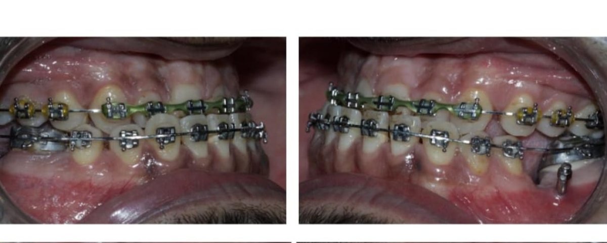Before and after braces results – teeth alignment improvement after orthodontic treatment