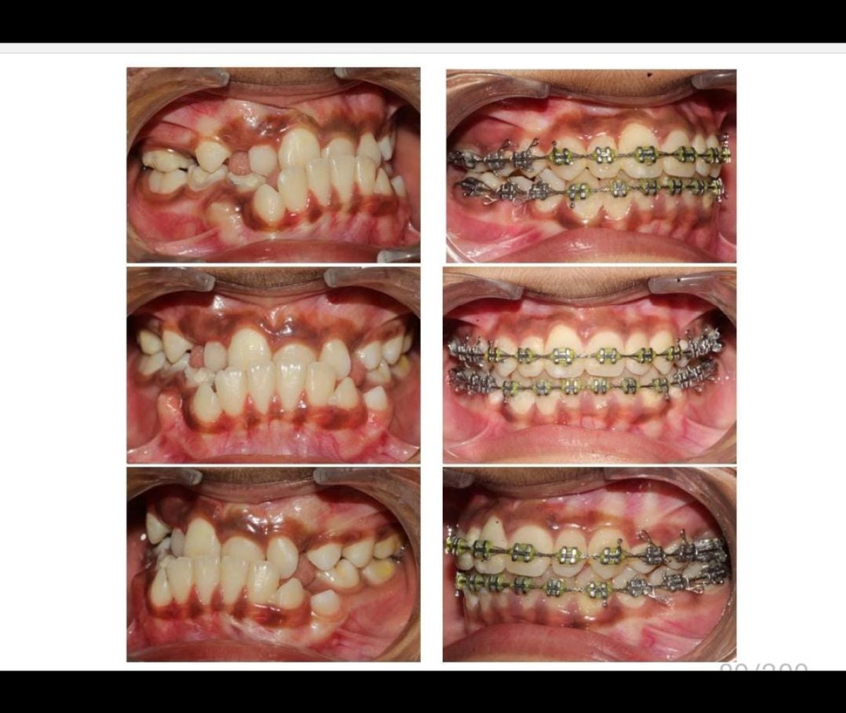 Before and after braces results – teeth alignment improvement with orthodontic treatment