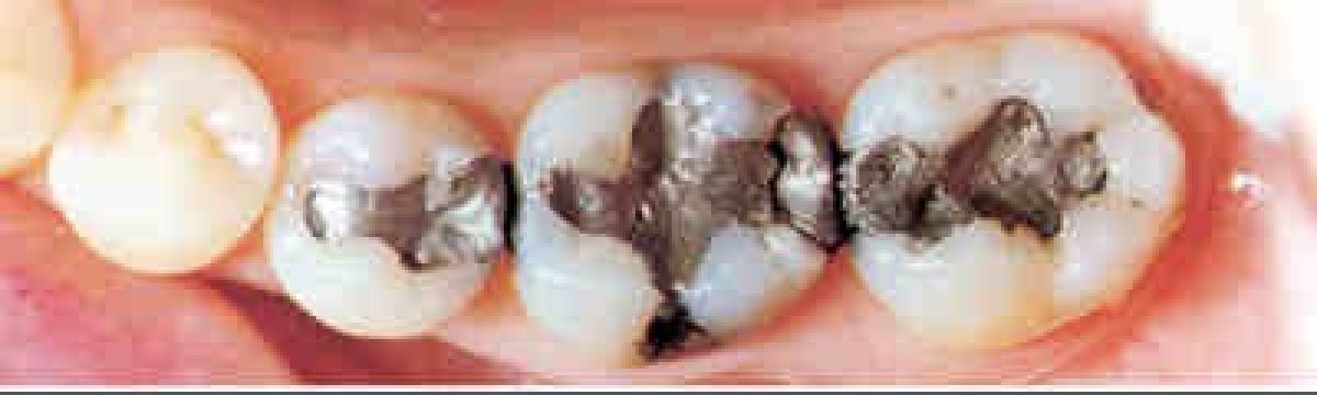 Avant restauration dentaire en clinique – caries et anciennes obturations métalliques résultat