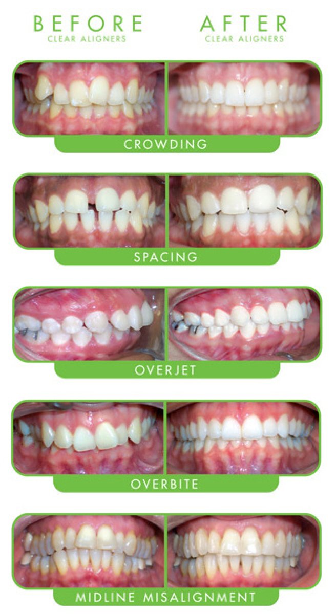 Before and after E-motion Aligners results for crowding, spacing, overjet, overbite, misalignment
