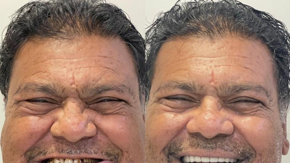 Resultado antes y después de la instalación de dentaduras completas: sonrisa mejorada
