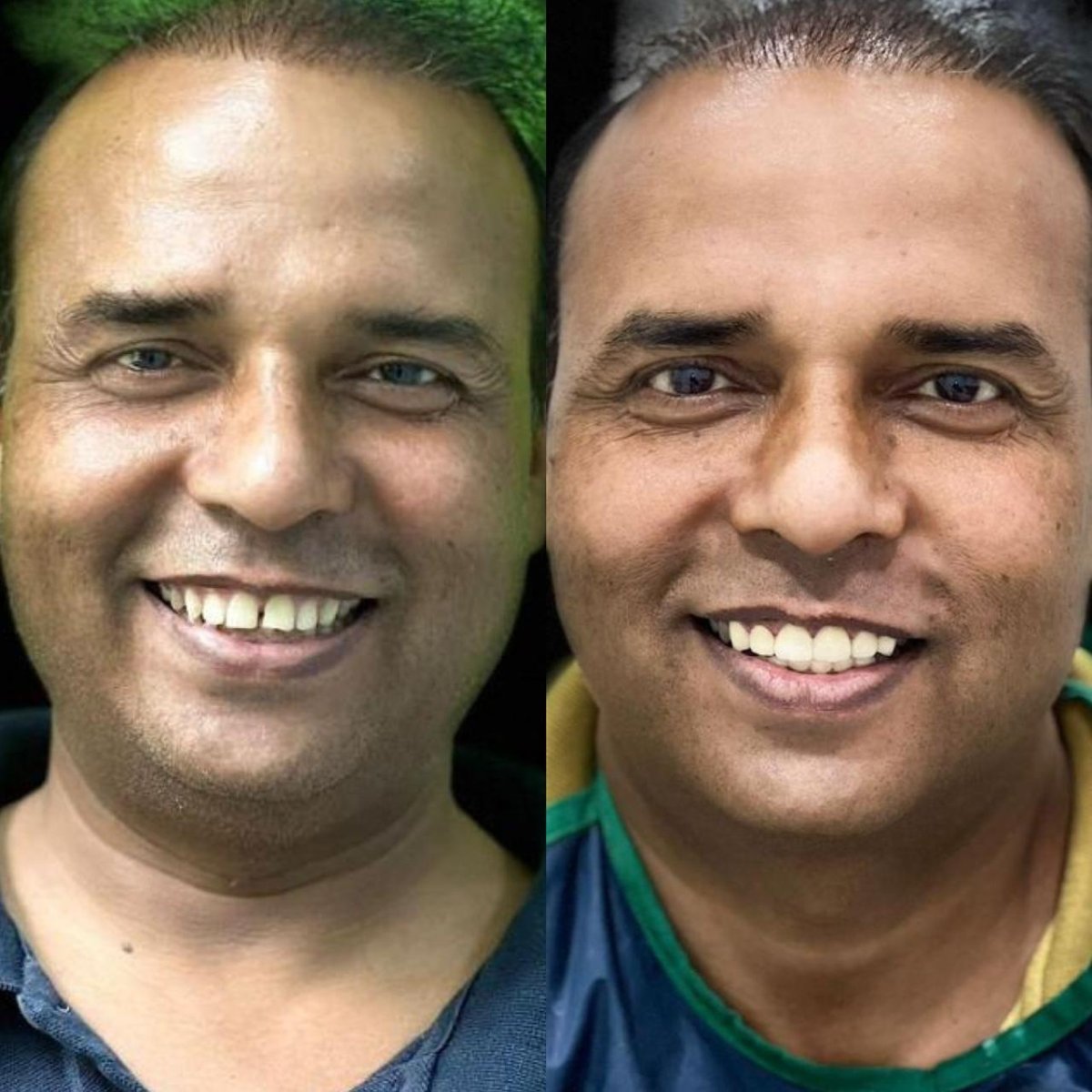 Smile makeover before and after results – improved teeth alignment and whiter smile