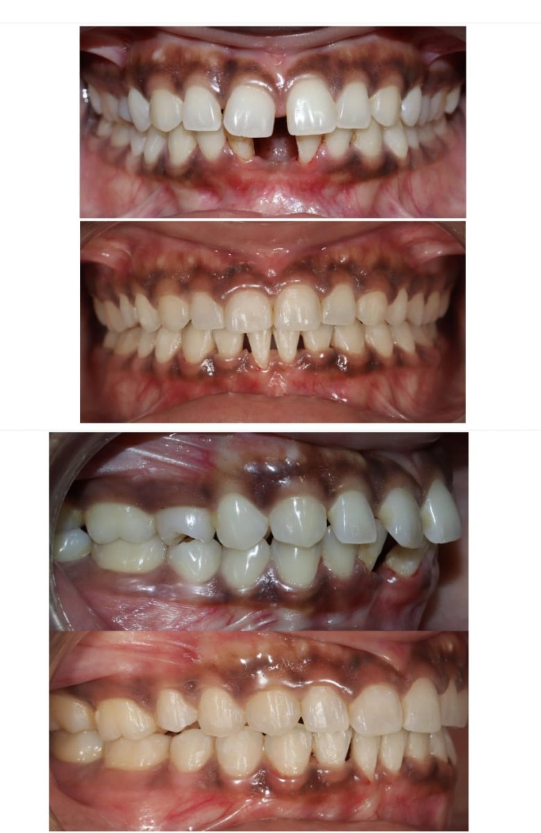 Smile makeover before and after results – improved teeth alignment and aesthetics