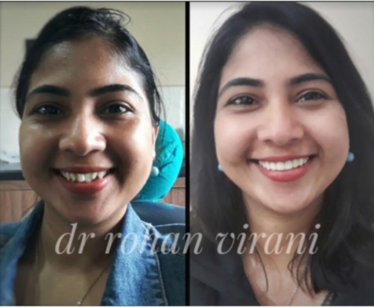 نتائج قبل وبعد تجميل الابتسامة مع د. رونان فيراني – تحسين انتظام الأسنان