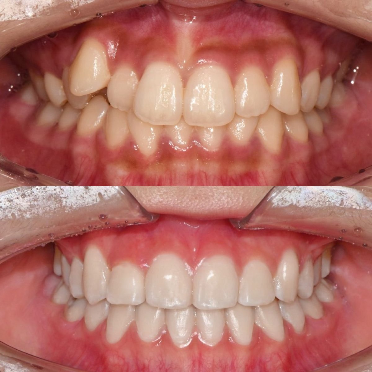 Resultados antes y después de brackets en 365 Seoul OneTop Dental Clinic, alineación dental mejorada