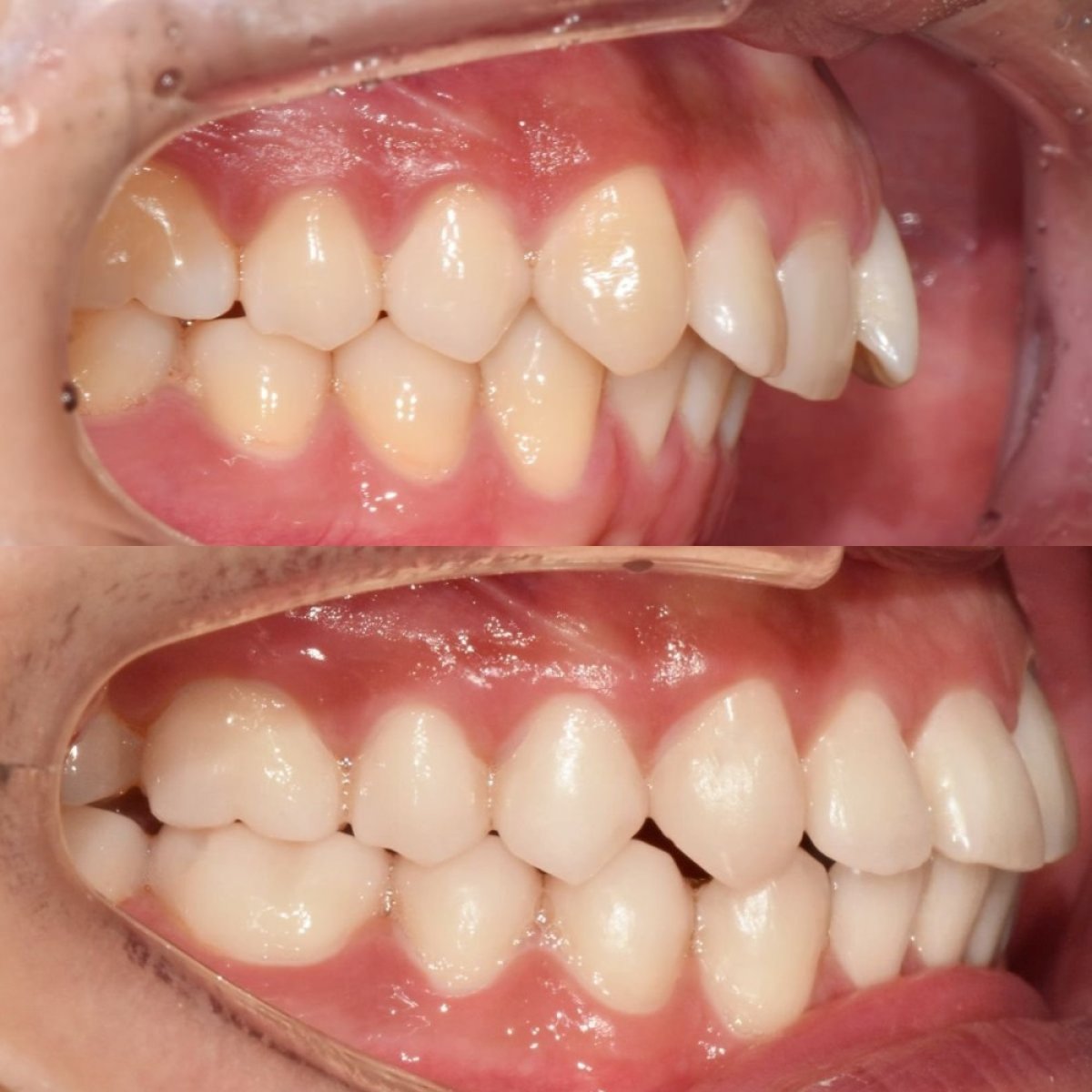 Vorher-nachher-Ergebnis Zahnspange bei 365 Seoul OneTop Dental Clinic – bessere Ausrichtung
