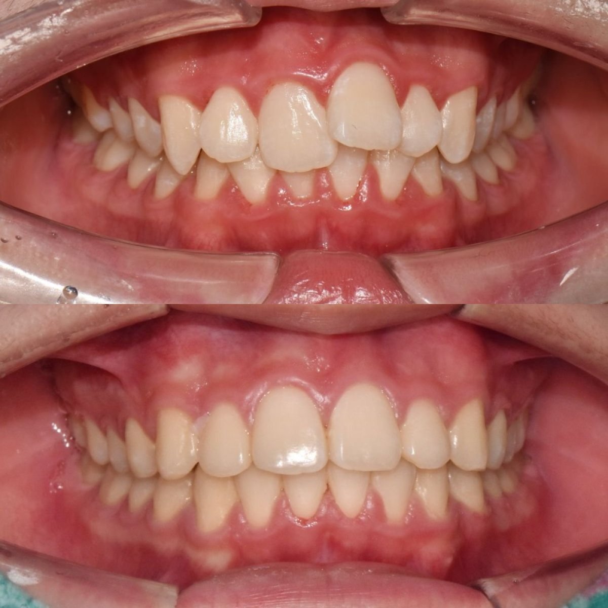 Vorher-nachher-Ergebnis Zahnspange bei 365 Seoul OneTop Dental Clinic, bessere Zahnstellung