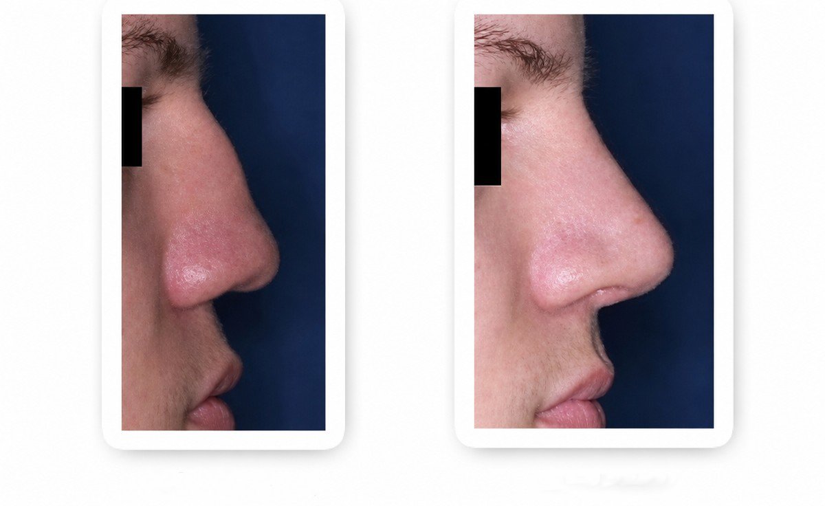 Before and after rhinoplasty results, nose reshaping with improved profile and contour