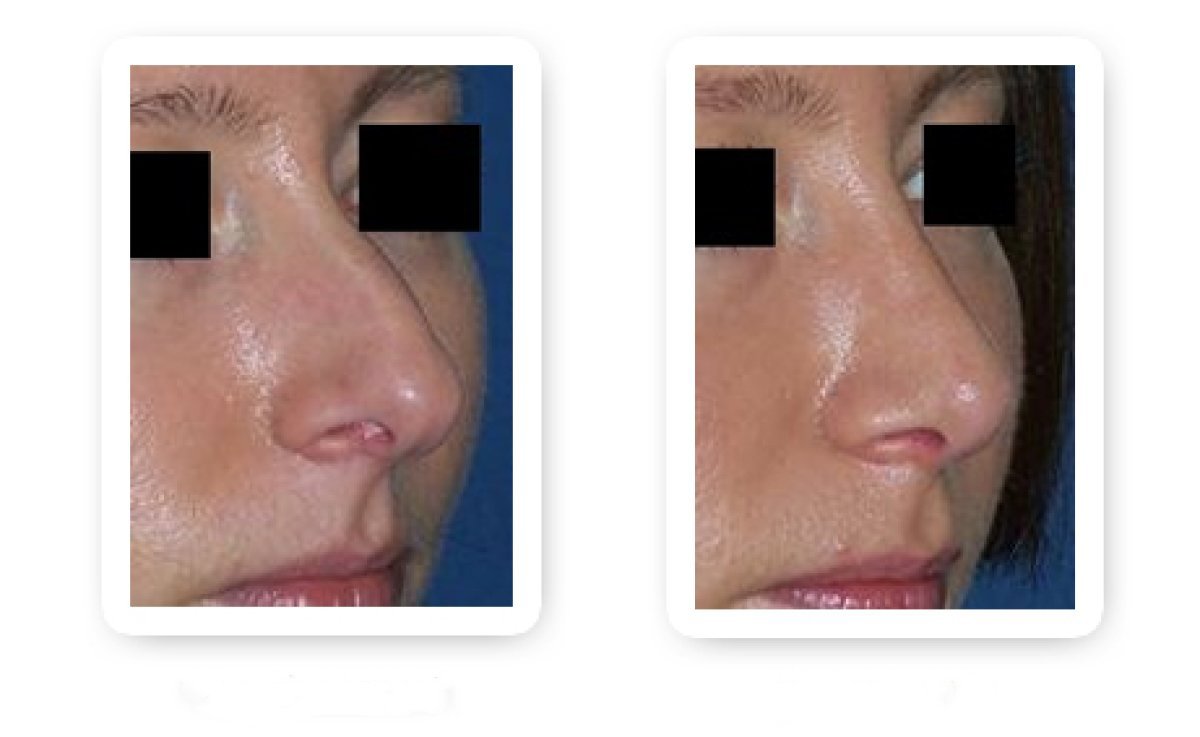نتائج عملية تجميل الأنف قبل وبعد، إعادة تشكيل الأنف وتحسين التناسق