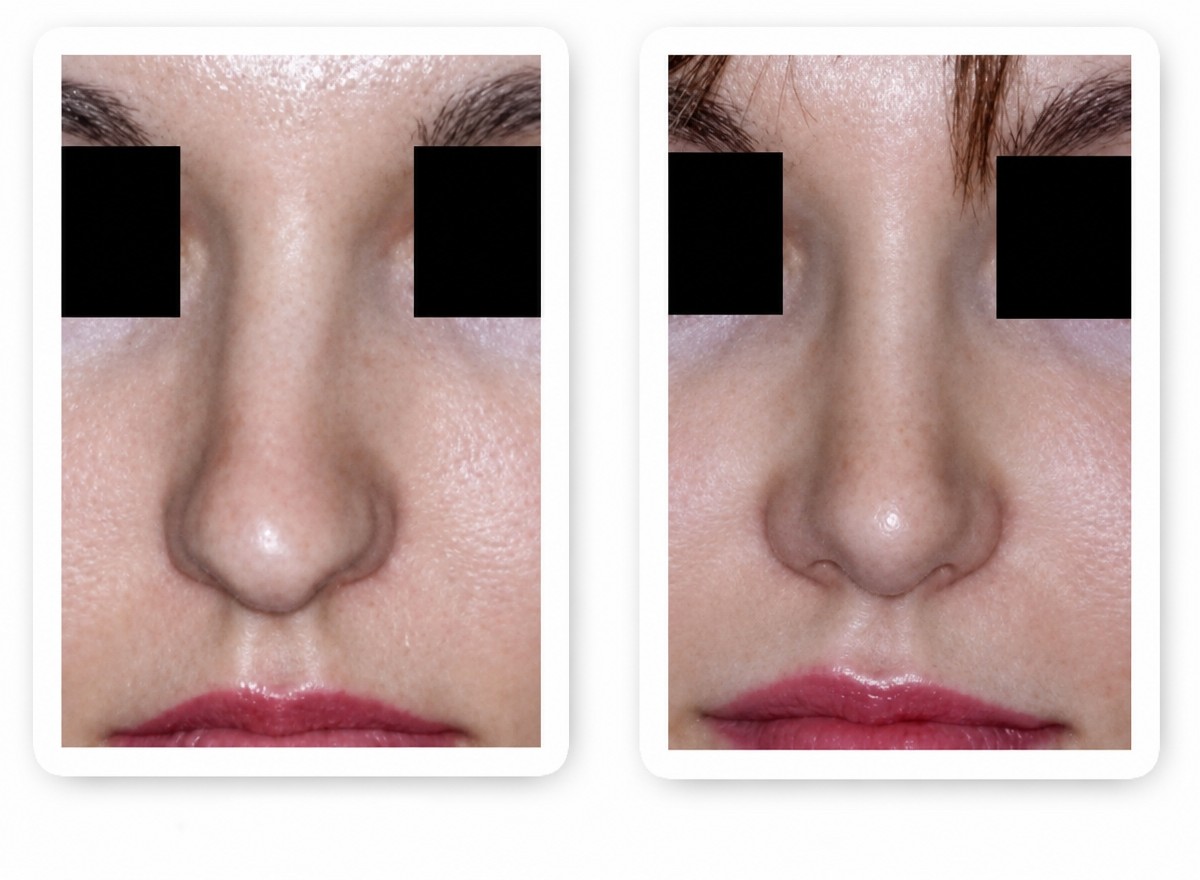نتائج عملية تجميل الأنف قبل وبعد، إعادة تشكيل الأنف لتحسين التناسق والشكل