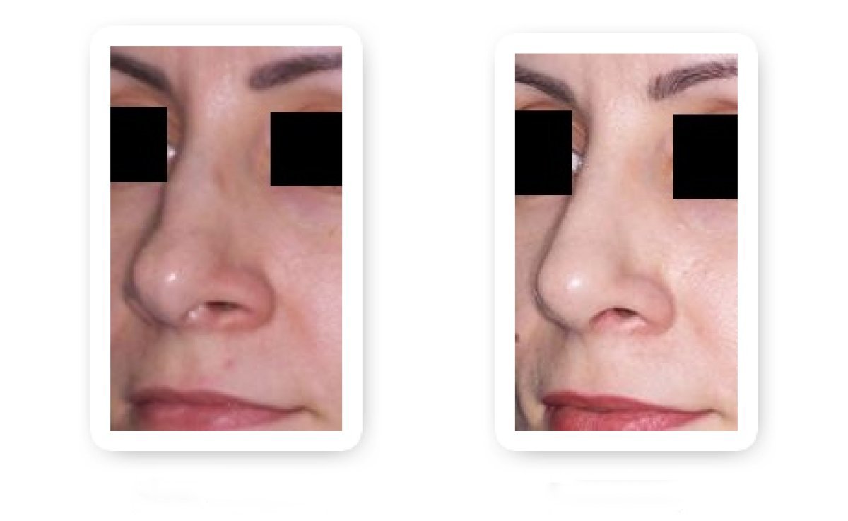 نتائج عملية تجميل الأنف قبل وبعد، تحسين شكل وتناسق الأنف