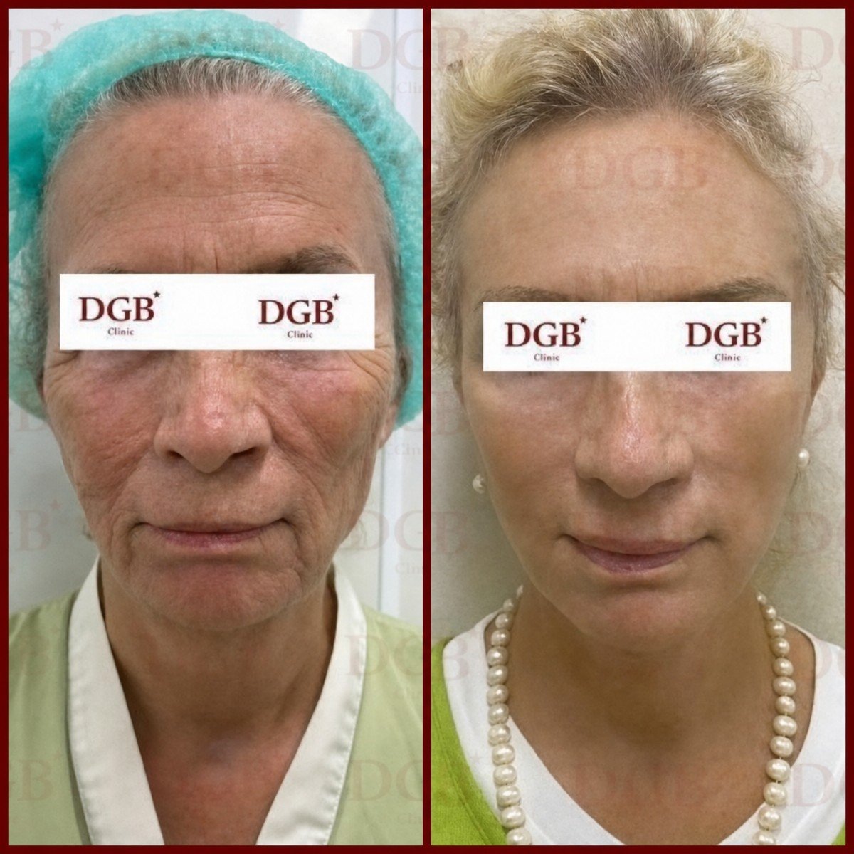 Resultados antes y después de deep plane facelift en DGB Clinic, rejuvenecimiento facial